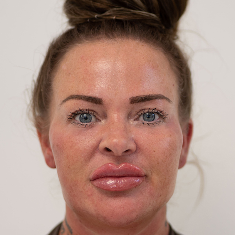 lip-filler-tear-through-filler-after