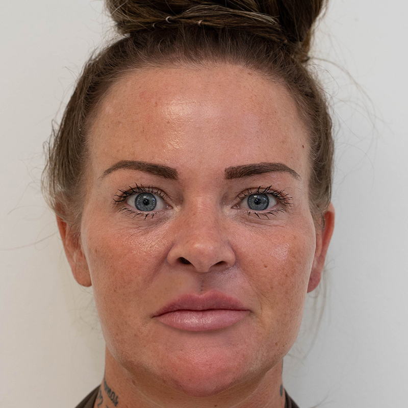 lip-filler-tear-through-filler-before