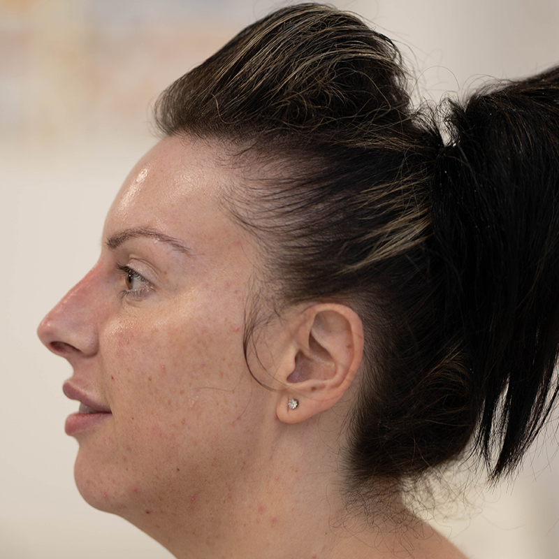 liquid-rhinoplasty-after