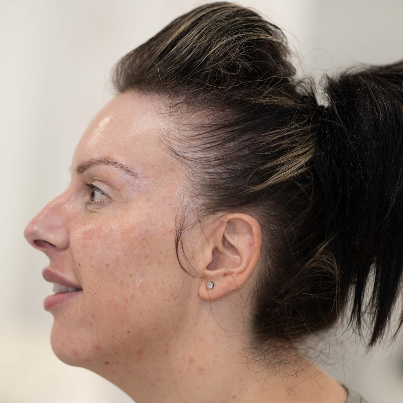 liquid-rhinoplasty-before