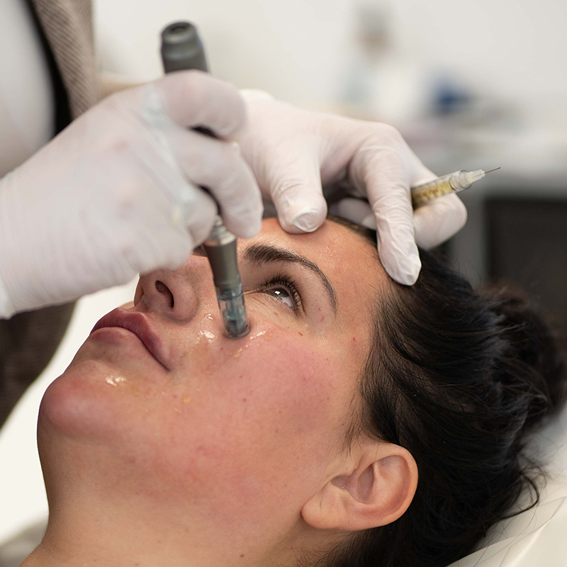 microneedling-face microneedling-face
