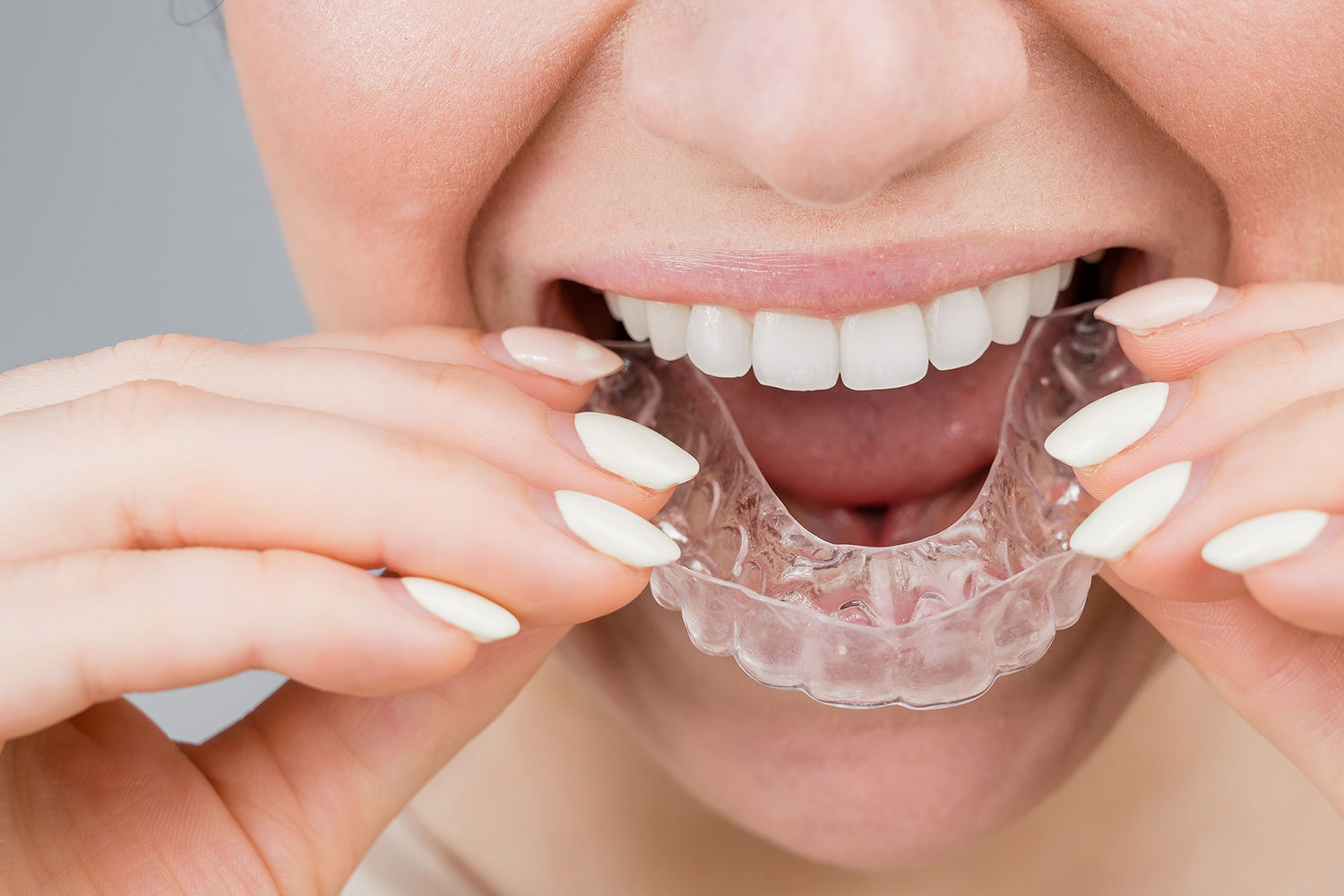 orthodontic-retainer-den