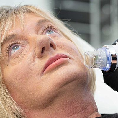rf-microneedling-course-shop