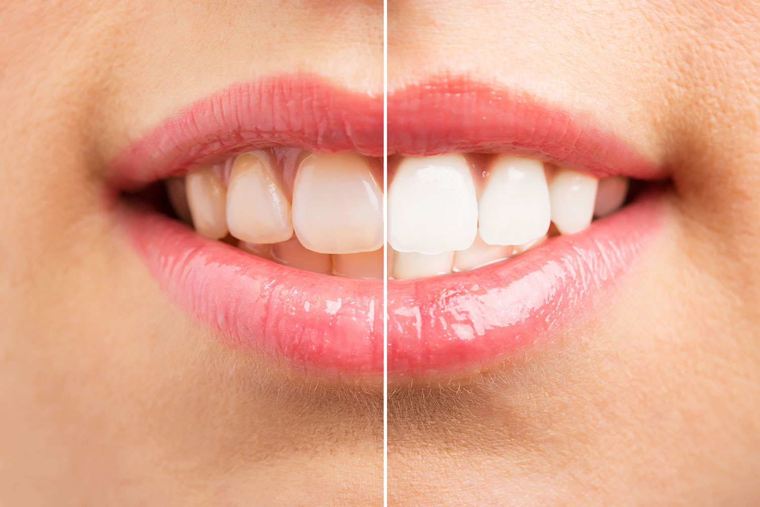 teeth-whitening
