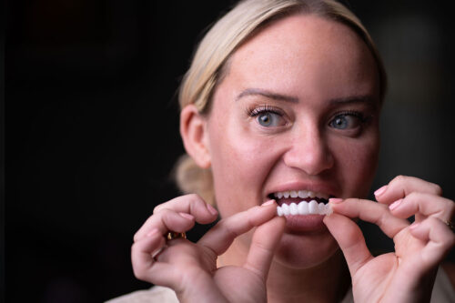 upper-only-one-veneer